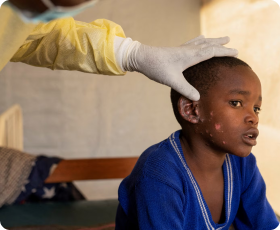 A little boy with mpox